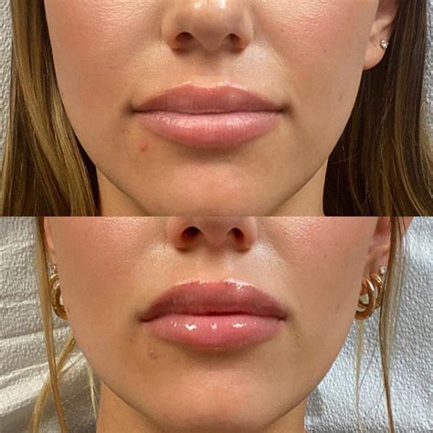 subtopic lip filler reviews